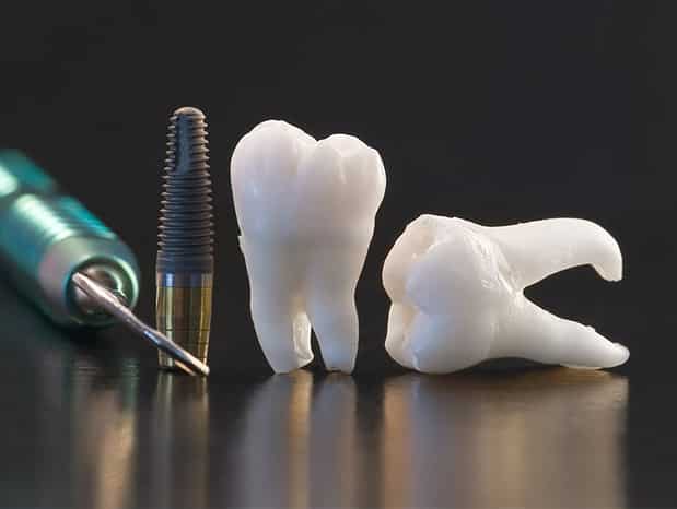 protesi-fissa-mobile-combinata-impianti-resina-ceramica-salerno-nuova-tecnologia-dentale-roberto-landi2
