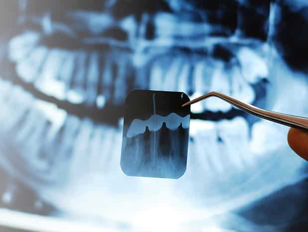 radiografia-digitale-bitewing-periapicale-panoramica-ortopanoramica-salerno-nuova-tecnologia-dentale-roberto-landi-1