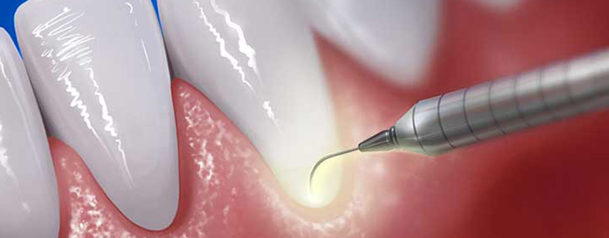 lawe-parodontologia